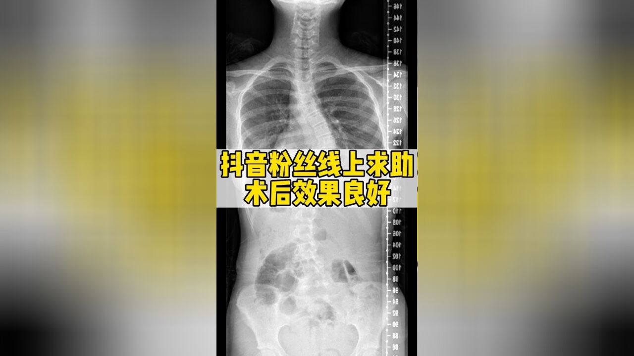 抖音粉丝线上求助,术后效果良好