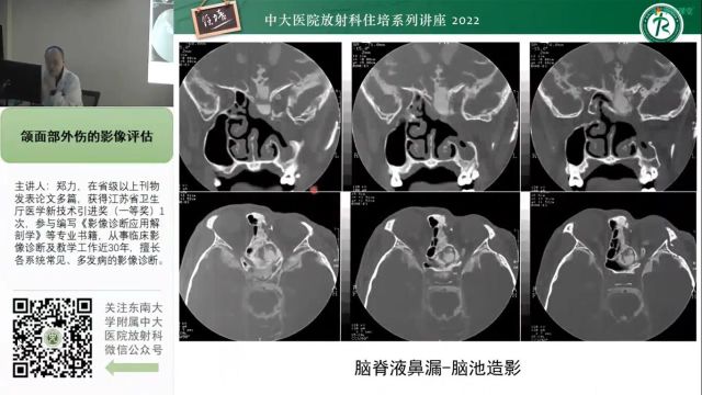 颌面部外伤的影像评估中大郑力