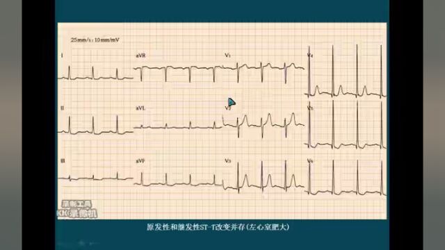 心电图词汇解释系列(六):原发性STT改变