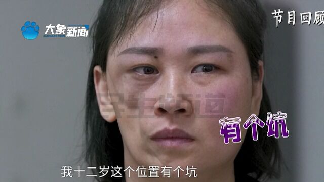 河南郑州:女子半边脸萎缩,想改善容貌像正常人,到整形医院进行脂肪填充