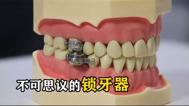 不可思议的“锁牙器”,在牙齿上装个螺栓,两周能掉6.36公斤