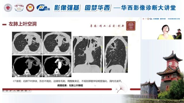 肺空洞性病变的影像分析四川大学华西医院余建群