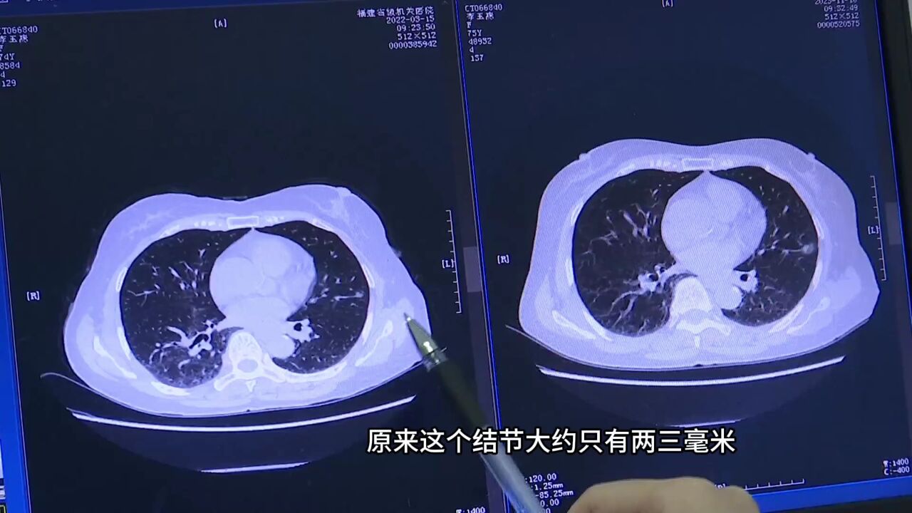 男子2毫米肺结节3年后变肺癌 医生教您看图识肺癌