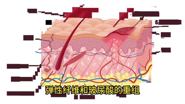 蛋白线面部提升后遗症