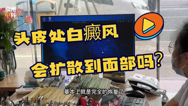 头皮处白癜风,会扩散到面部吗?漳州白癜风医院专业治疗白癜风【白癜风扩散怎么办】