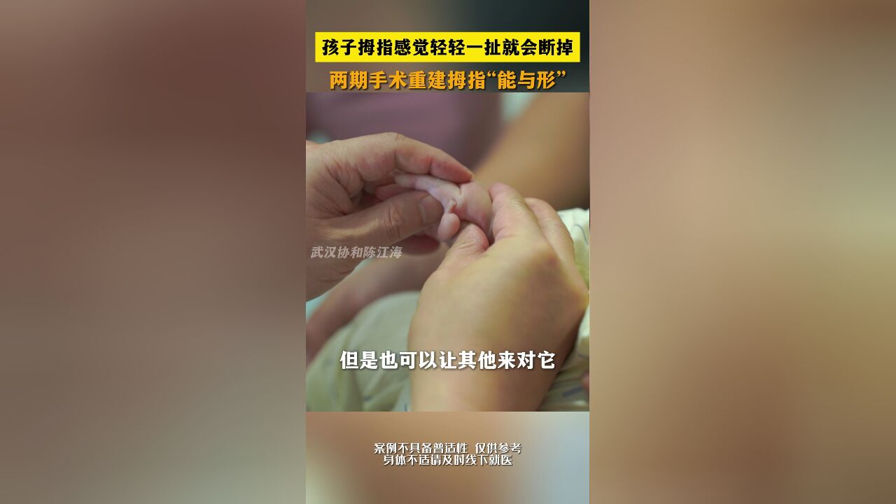 孩子拇指感觉轻轻一扯就会断掉,两期手术重建拇指“能与形”