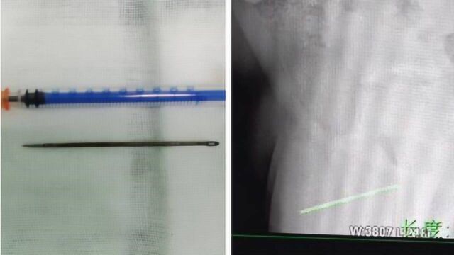 12岁男孩将8厘米长针插入尿道 医生:正值青春期懵懂好奇