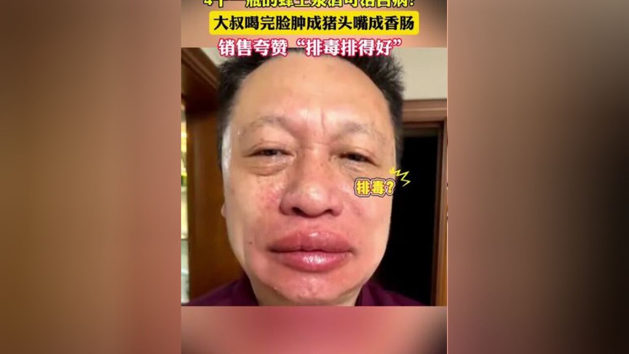 男子喝蜂王浆酒脸肿成猪头