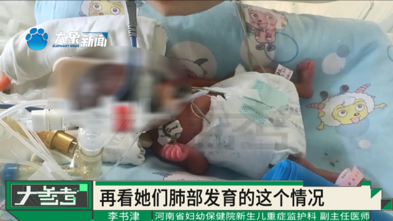 河南郑州:婴儿体重700多克!孕妇怀孕28周后身体不适,剖宫产下双胞胎