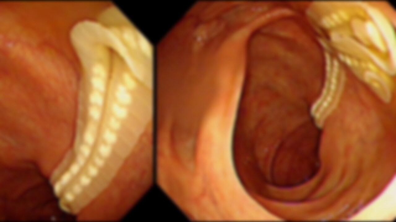 男子身价过亿爱吃刺身,全麻做胃肠镜揪出60cm活虫,医生提醒