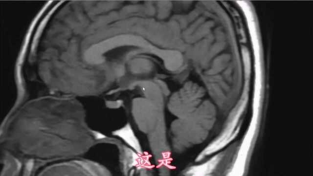 头部磁共振解剖,常见疾病该怎么看?医生告诉你答案