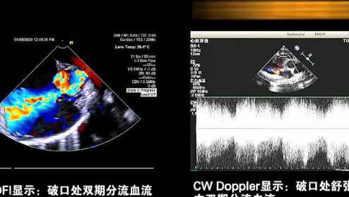 多普勒超声表现__C_PW_CW
