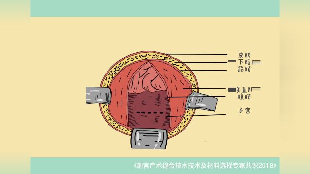 腹直肌分离知多少