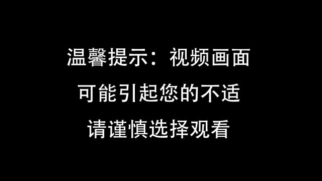 脚底黄色疣,一点一点去除死皮