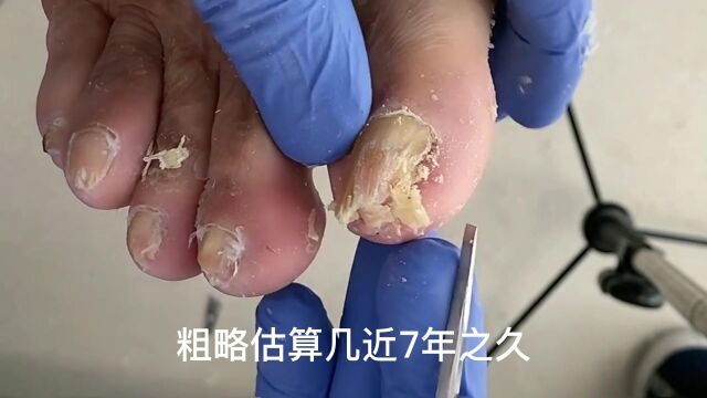 灰指甲、甲沟炎嵌甲是怎么回事呢?灰指甲特效药?