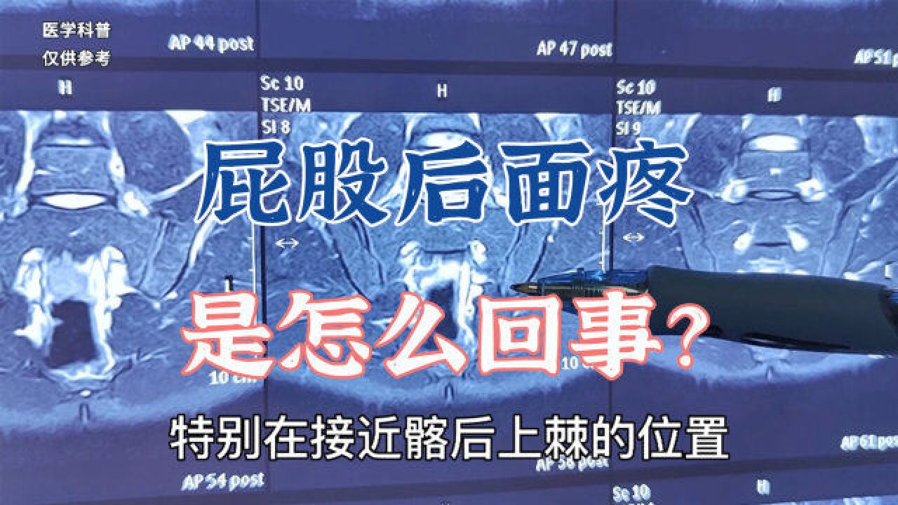 患者屁股后面痛是怎么回事?肖医生阅片讲解早期的强直性脊柱炎