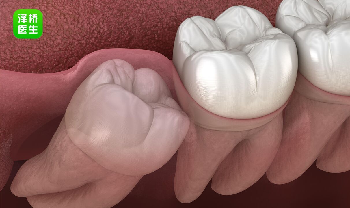 智齿一定要拔掉吗?不疼可以不管?专家终于讲清楚了