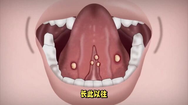 口腔溃疡常见的原因及治疗方法