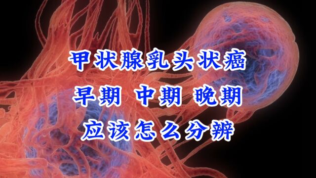 甲状腺癌早期中期晚期怎么分辨?其实很简单,张医生告诉你答案