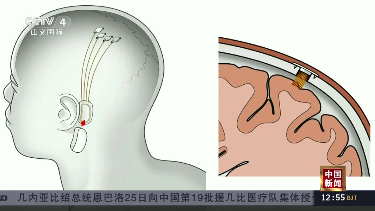 美国:马斯克旗下脑机接口公司获准启动人体临床试验