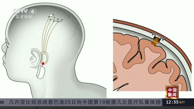 美国:马斯克旗下脑机接口公司获准启动人体临床试验