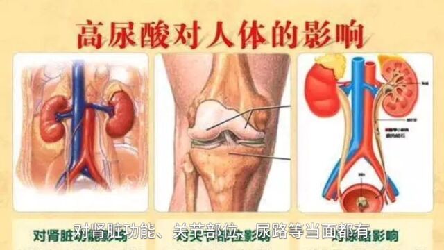 高尿酸血症之一酸到底的危害