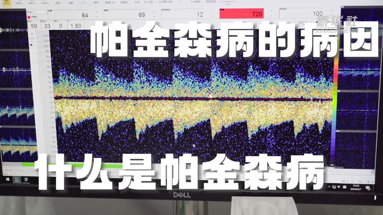 科学防治帕金森病,提升“帕友”生活质量