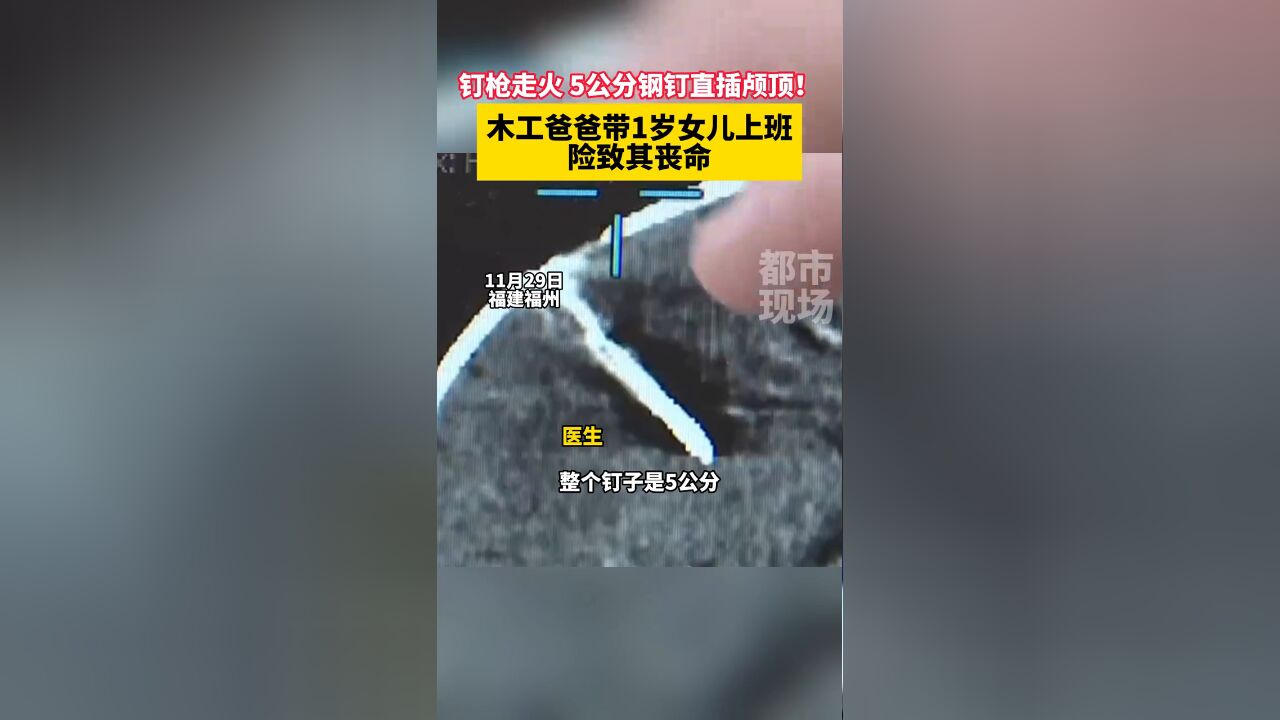 钉枪走火 5公分钢钉直插颅顶!木工爸爸带1岁女儿上班险丧命