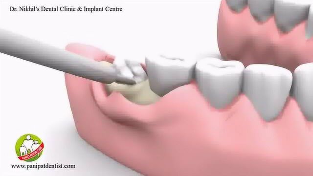 动画解析拔智齿的过程,长出一点点的智齿如何拔除的!