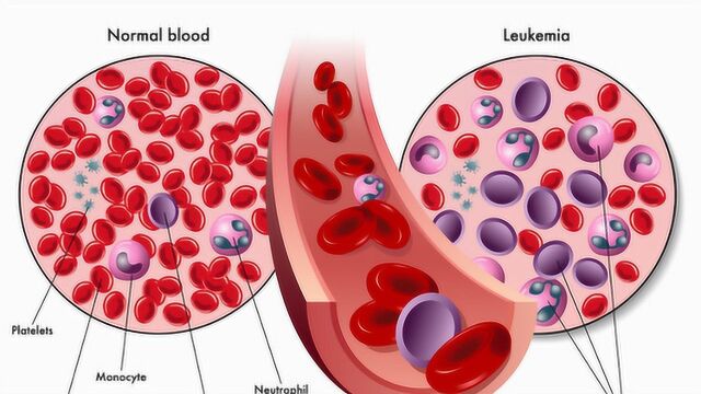 白血病又有新疗法,缓解率可达90%以上,你了解吗?