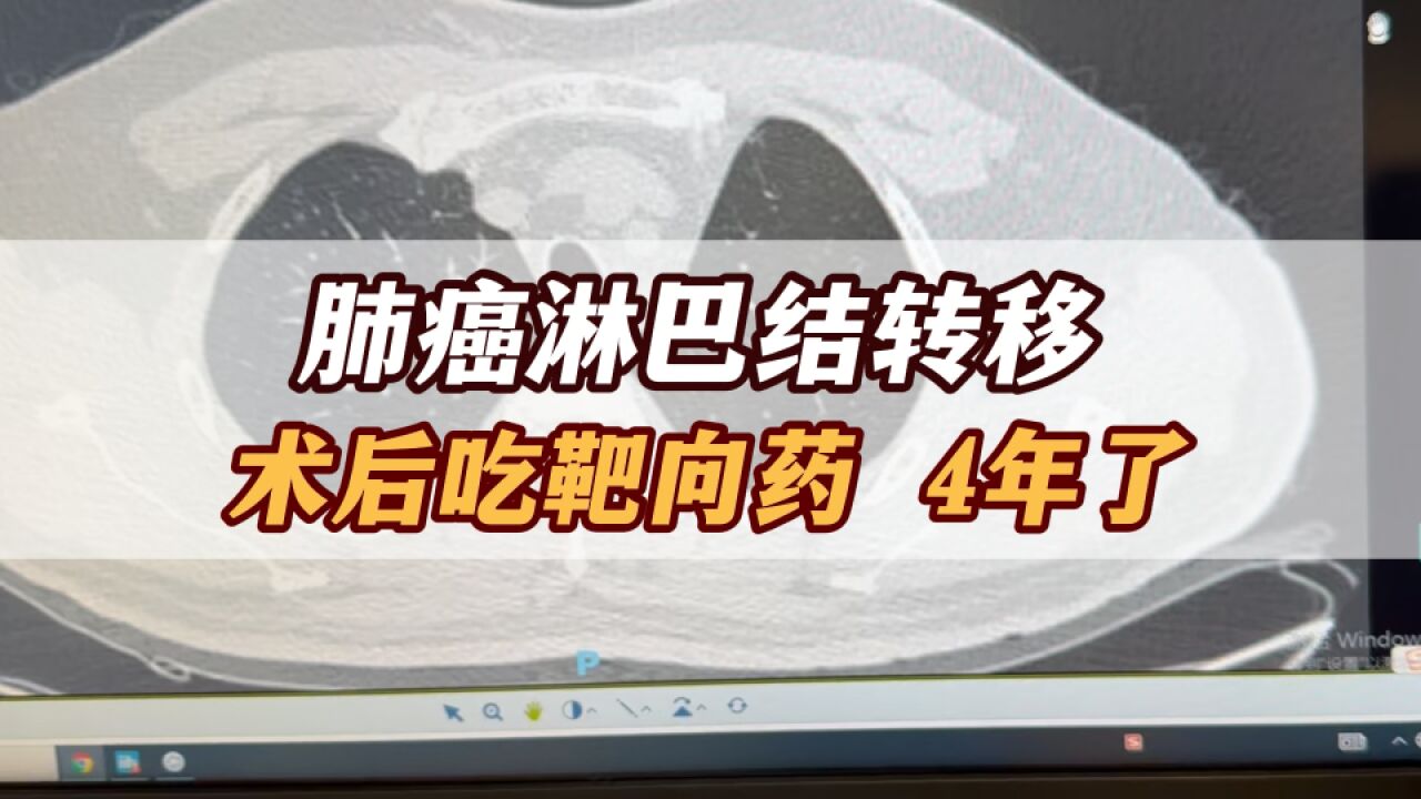 肺癌有淋巴结转移,术后吃靶向药4年,病人现在情况怎么样?