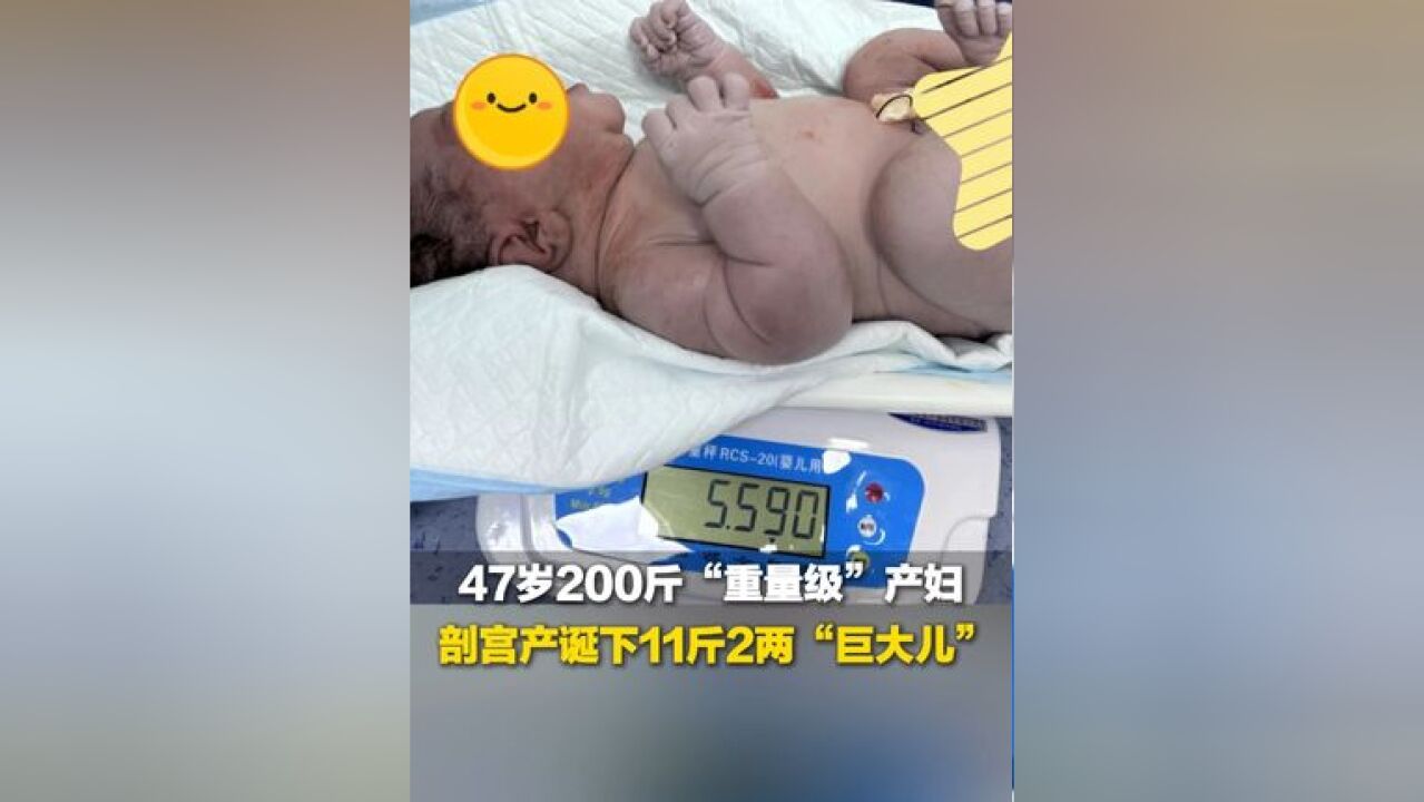 四川47岁200斤产妇剖宫产诞下11斤2两巨大儿 身高不足160公分 曾顺产三胎