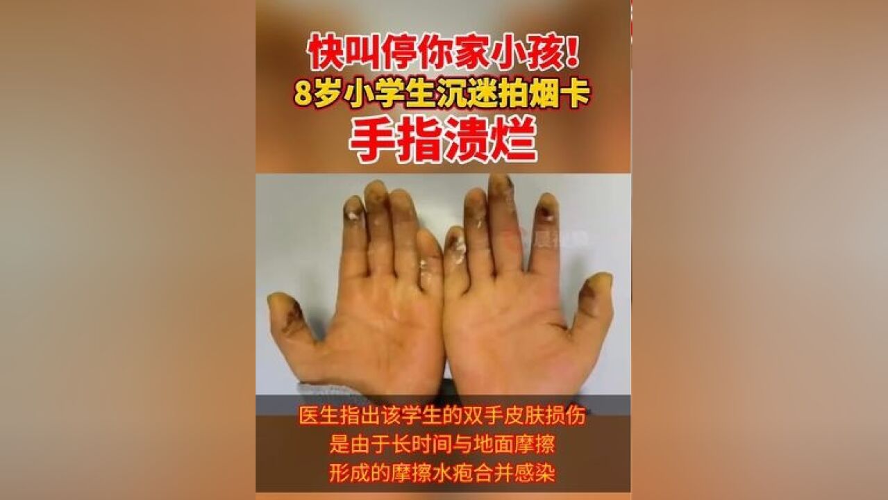 快叫停你家小孩!8岁小学生沉迷拍烟卡手指溃烂