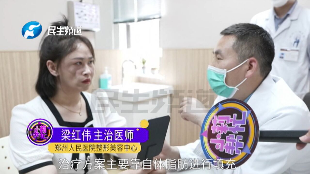 河南郑州:女子半边脸萎缩,想改善容貌像正常人,到整形医院进行脂肪填充