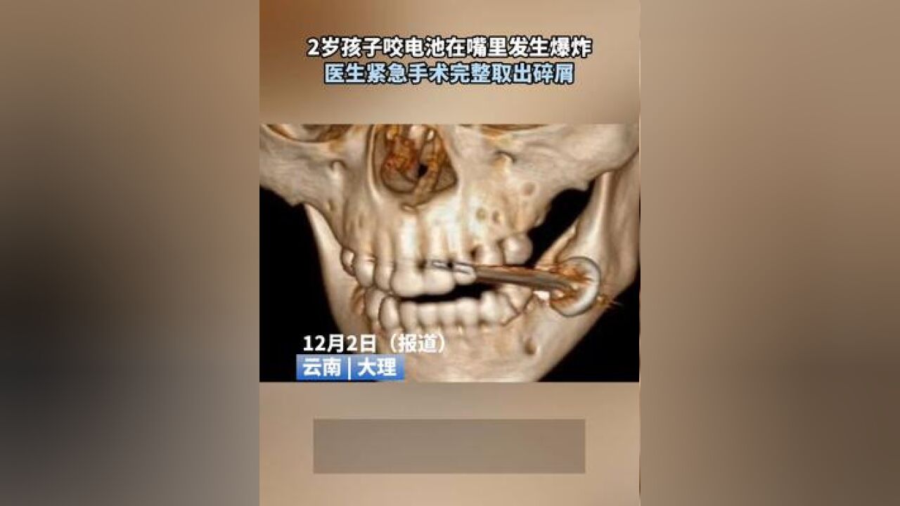 2岁孩子咬电池在嘴里发生爆炸,医生紧急手术完整取出碎屑