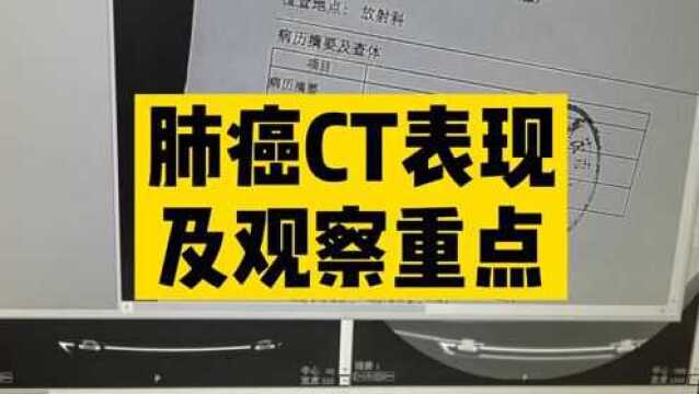 肺癌在CT上是什么样的,影像初学者应该重点观察哪些地方,放射科医生讲解