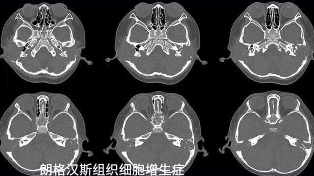 影像诊断:朗格汉斯组织细胞增生症