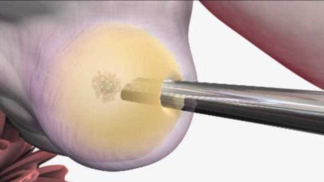 女性到底是怎么“取卵”的?医生说出全过程,看完令人害怕!