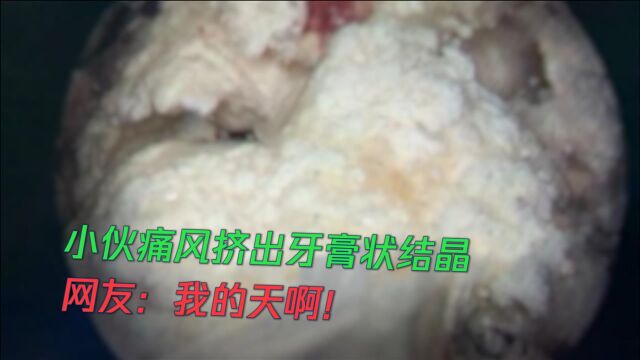 小伙痛风挤出牙膏状结晶!痛风如何预防?听听医生建议!