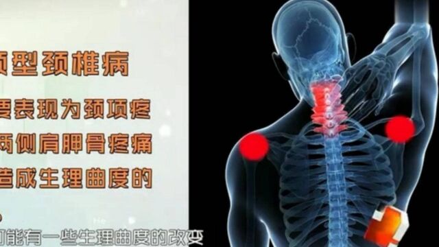 颈椎病的表现类型不同,专家现场一一分析,赶紧看看早发现早治疗