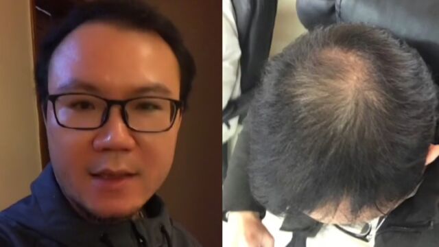 男子秃顶后求医无效,尝试半个月不用洗发水竟长出头发:又粗又硬