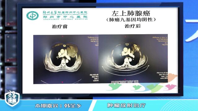 肿瘤放疗方式及其特点