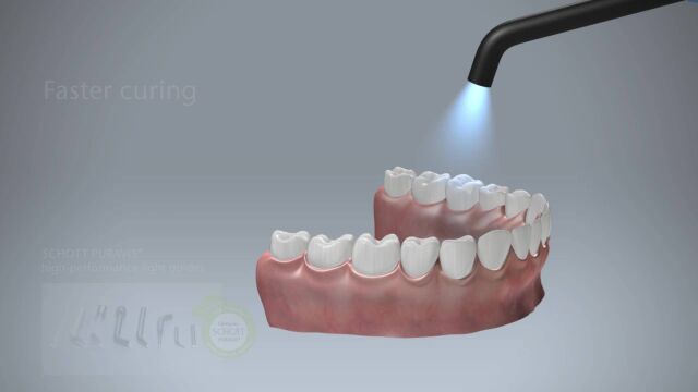 肖特光导如何改进牙科固化过程