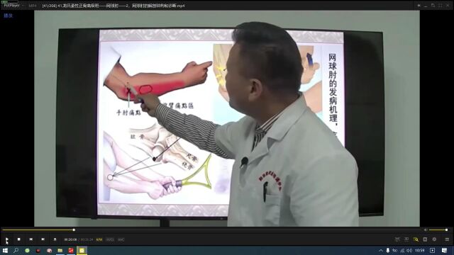 肱骨外上髁炎网球手网球肘检查病理基础理论