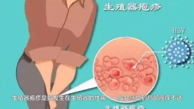 漳州九龙医院介绍:生殖器疱疹治疗期间如何护理