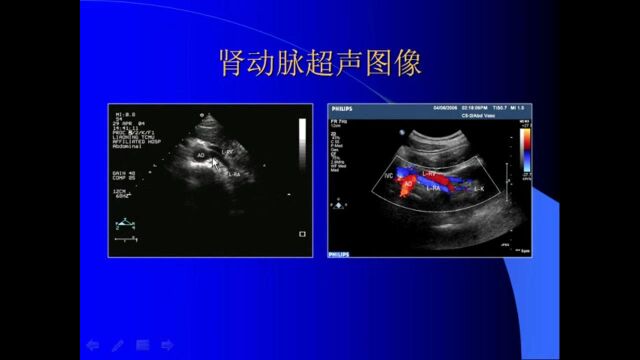 cdfi彩色超声医学考试教学视频第十五章腹部血管