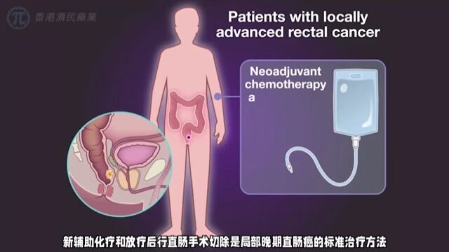 Jemperli(dostarlimabgxly)可用于dMMR局部晚期直肠癌的治疗 患者不仅完全缓释还可省略放化疗 