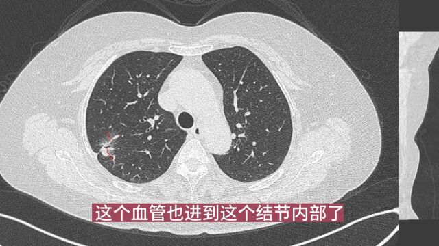 混合磨玻璃结节,4个细节提示肺癌,诊断不难,应手术