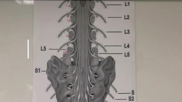 腰椎间盘突出最怕造成马尾综合征,那什么是马尾神经呢?#腰椎间盘突出 #马尾综合征 #马尾神经 #脊柱微创杨文成