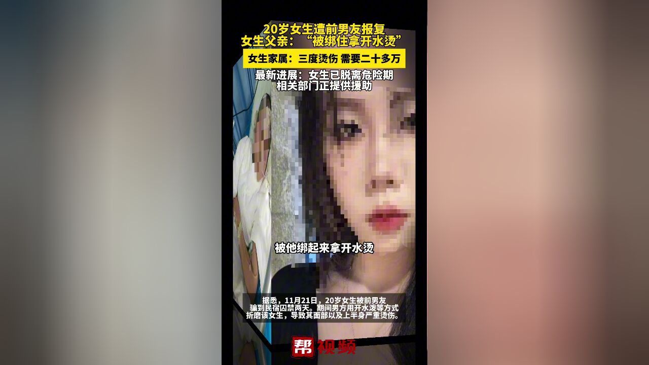 20岁女生遭前男友报复 女生父亲:“被绑住拿开水烫”